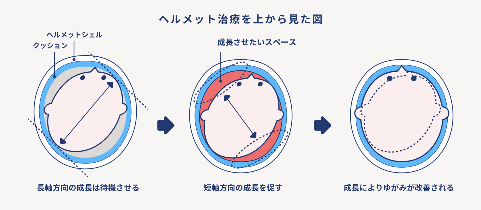 赤ちゃんのための頭のかたち外来